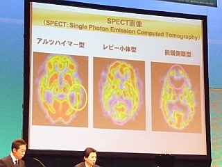 写真:SPECT画像