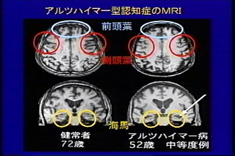 MRIを使った脳の断層撮影の図が左列に２つ右列に２つ