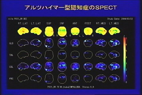 SPECTのデータを画像にしたものが40並んでいる図