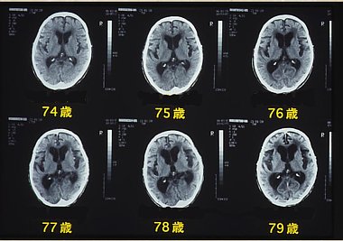 脳のＣＴ画像。内容は本文の通り