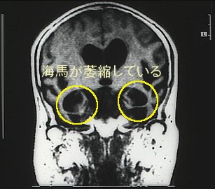 脳のMRI画像。内容は本文の通り。